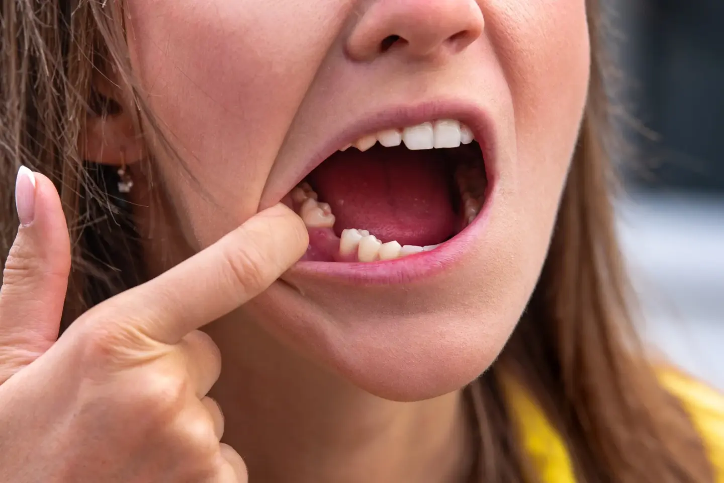 knocked-out tooth