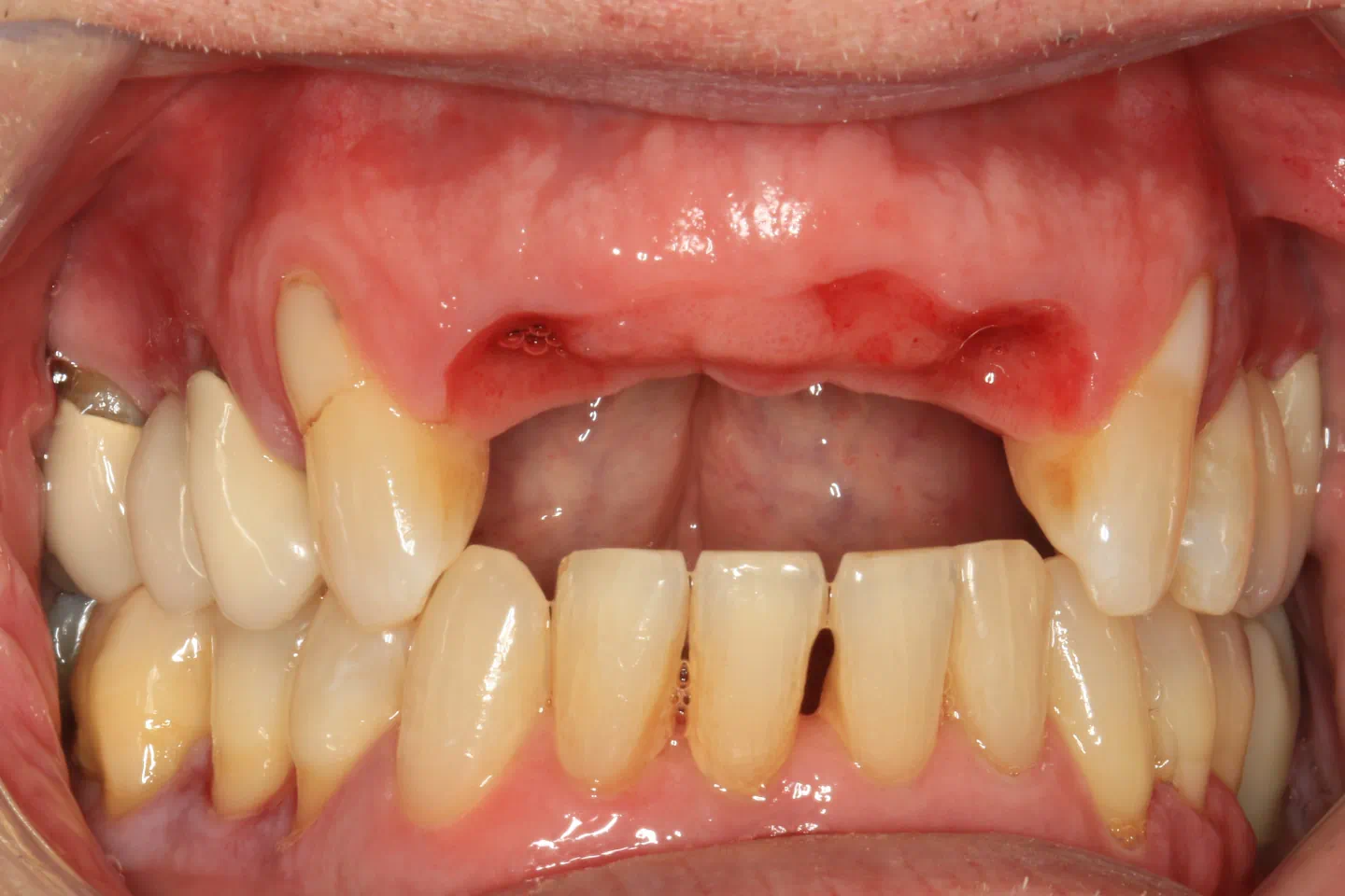 Before cosmetic implant treatment