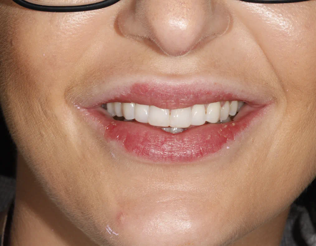 Inman Aligner