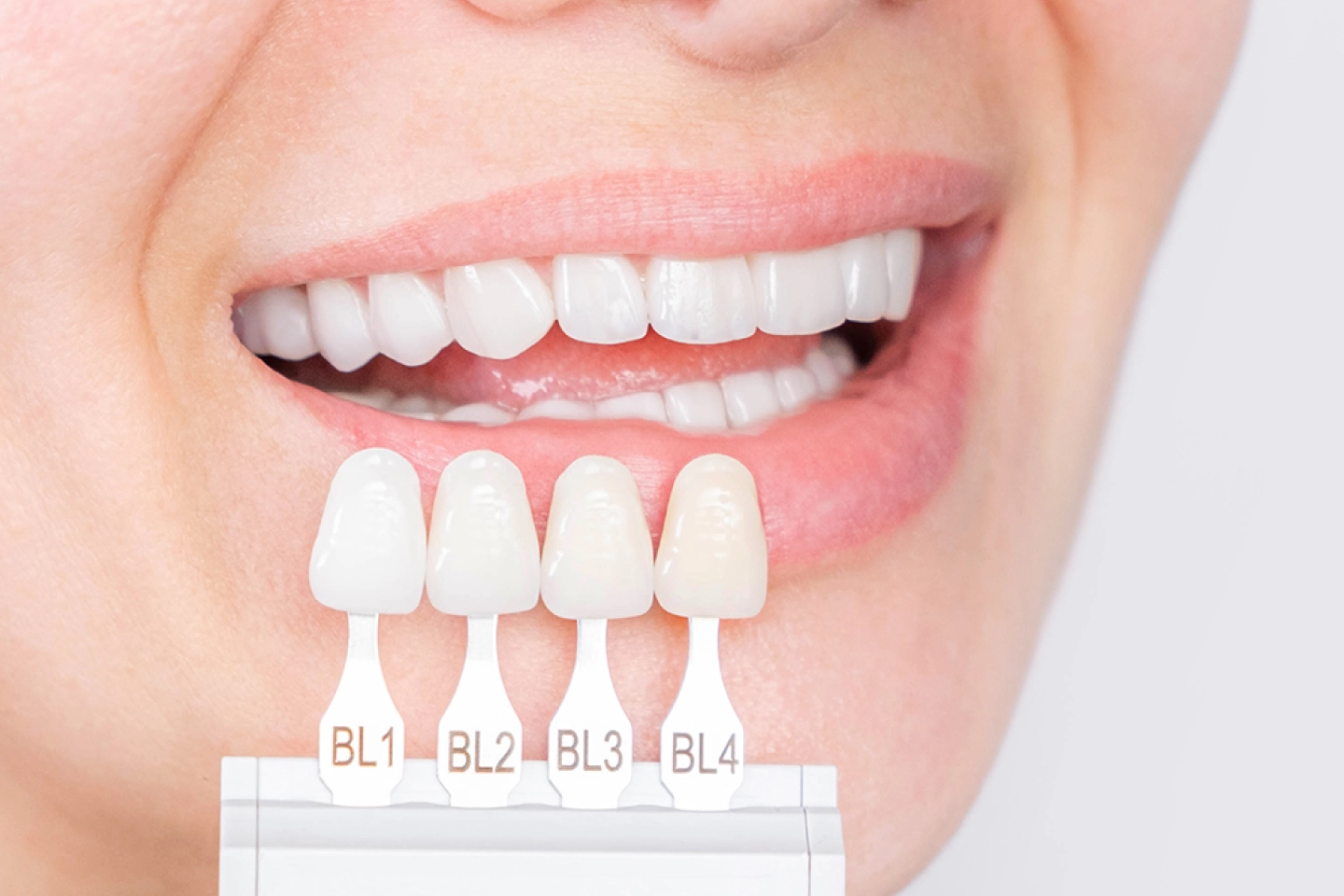 Porcelain Veneers, Cosmetic Procedures at Ripon Dental