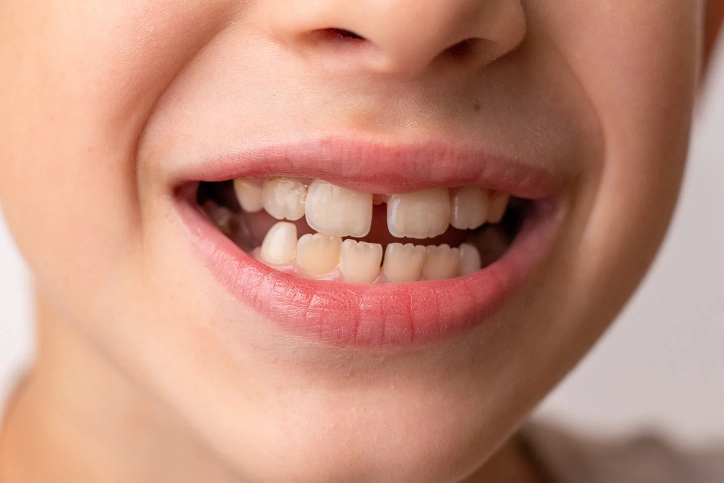 How to Fix Gaps Between Teeth Without Traditional Braces