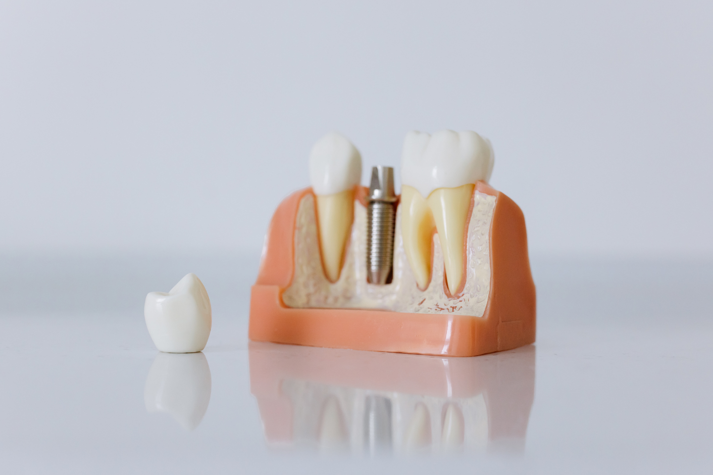 Evolution of Dental Crowns