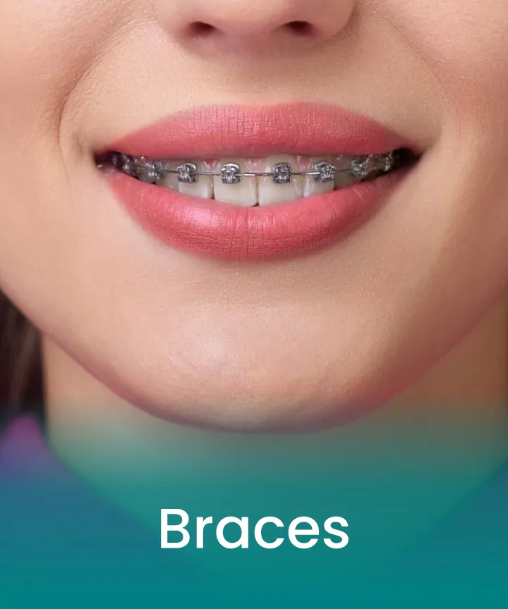 Braces