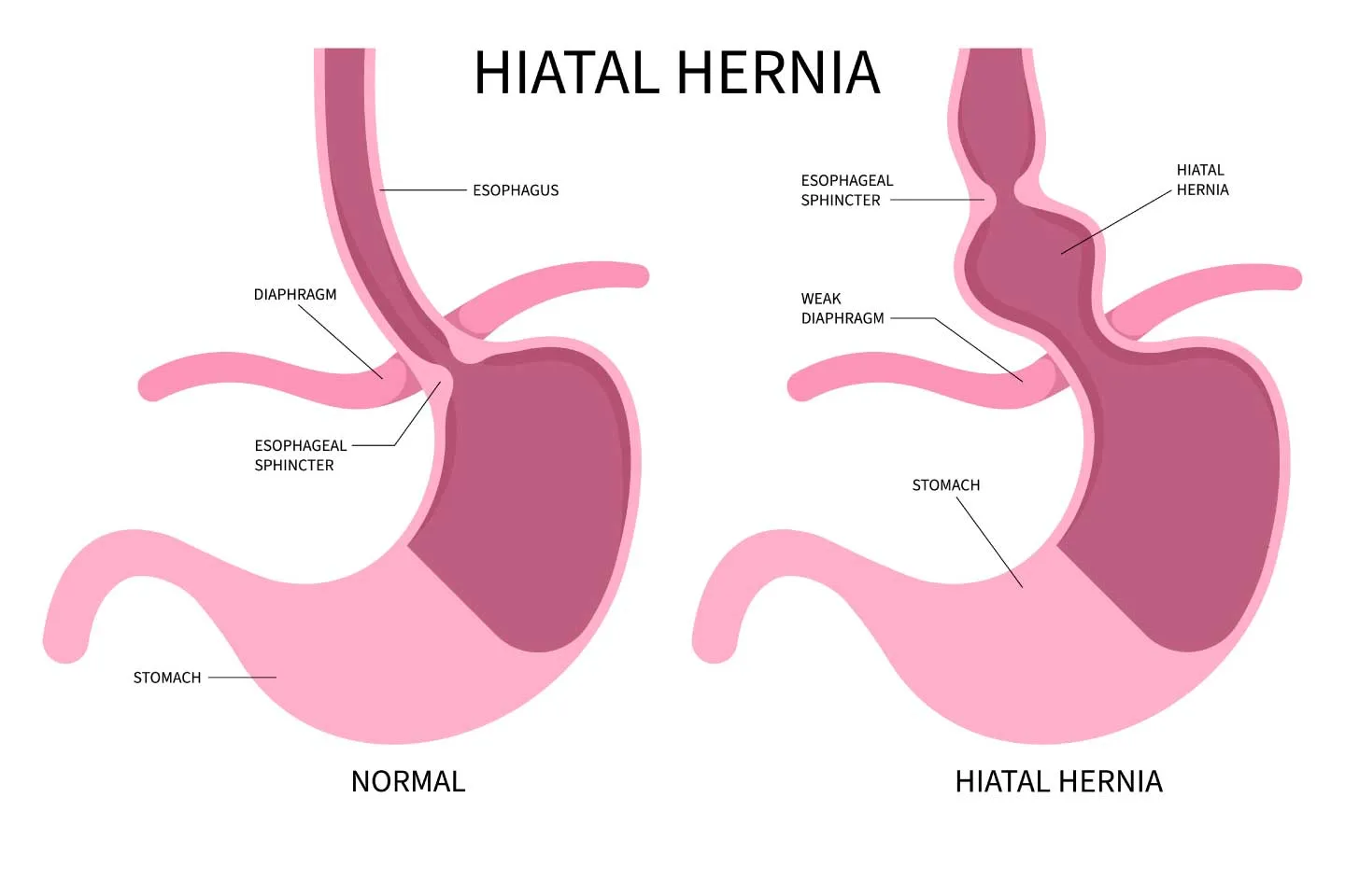 Understanding Hiatal Hernia