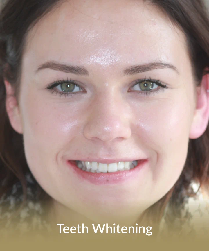 Teeth whitening