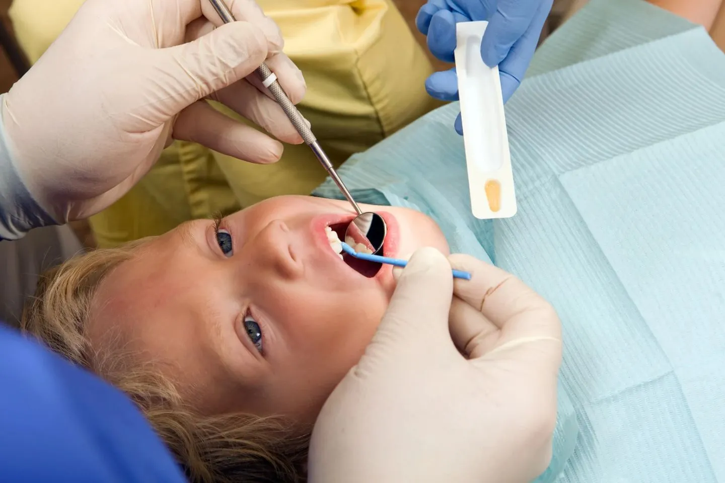 Silver diamine fluoride cavity treatment