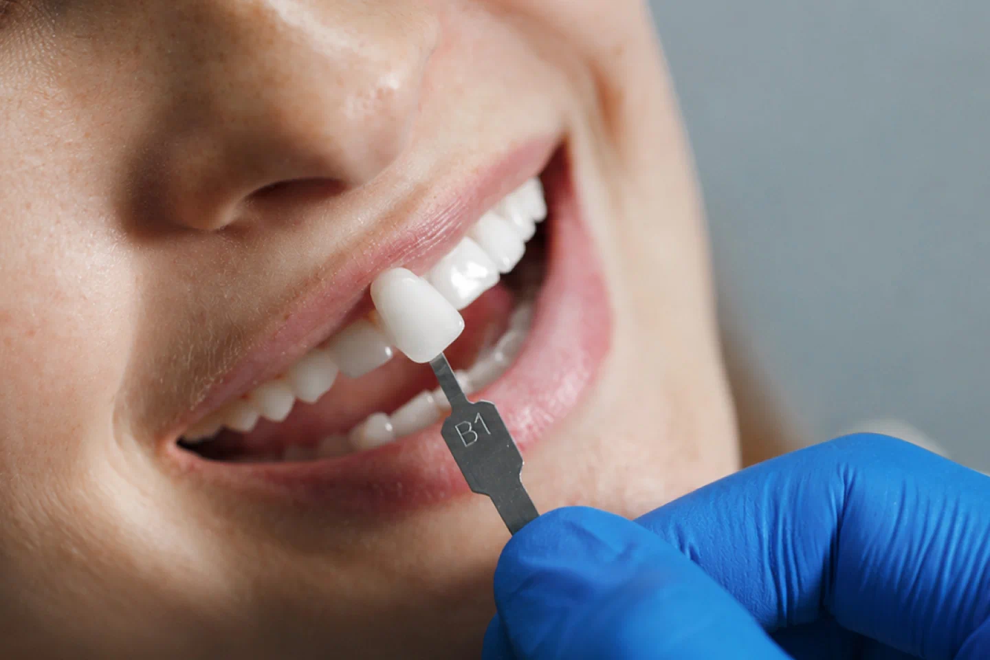 Understanding the Risks of Dental Veneers