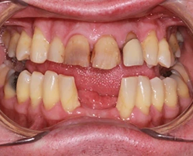 Missing Front Teeth
