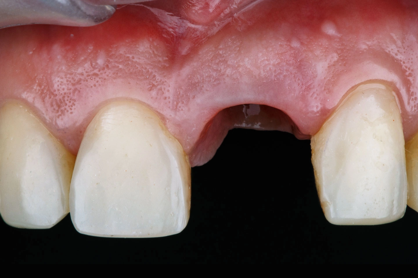 Options for Replacing Missing Teeth