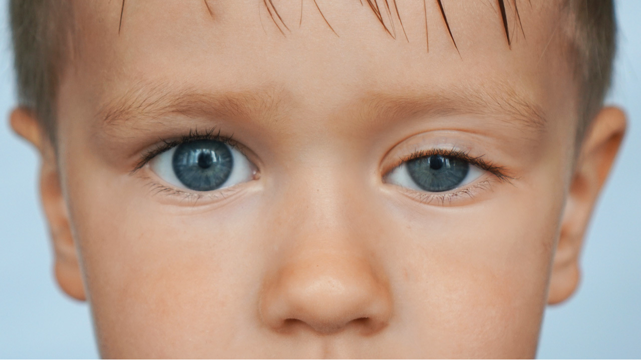 Eye icon showing one eyelid drooping while the other stays normal — simple outline highlighting eyelid position.