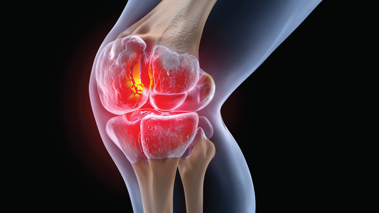 Orthopedic surgeon planning high tibial osteotomy for knee joint preservation.