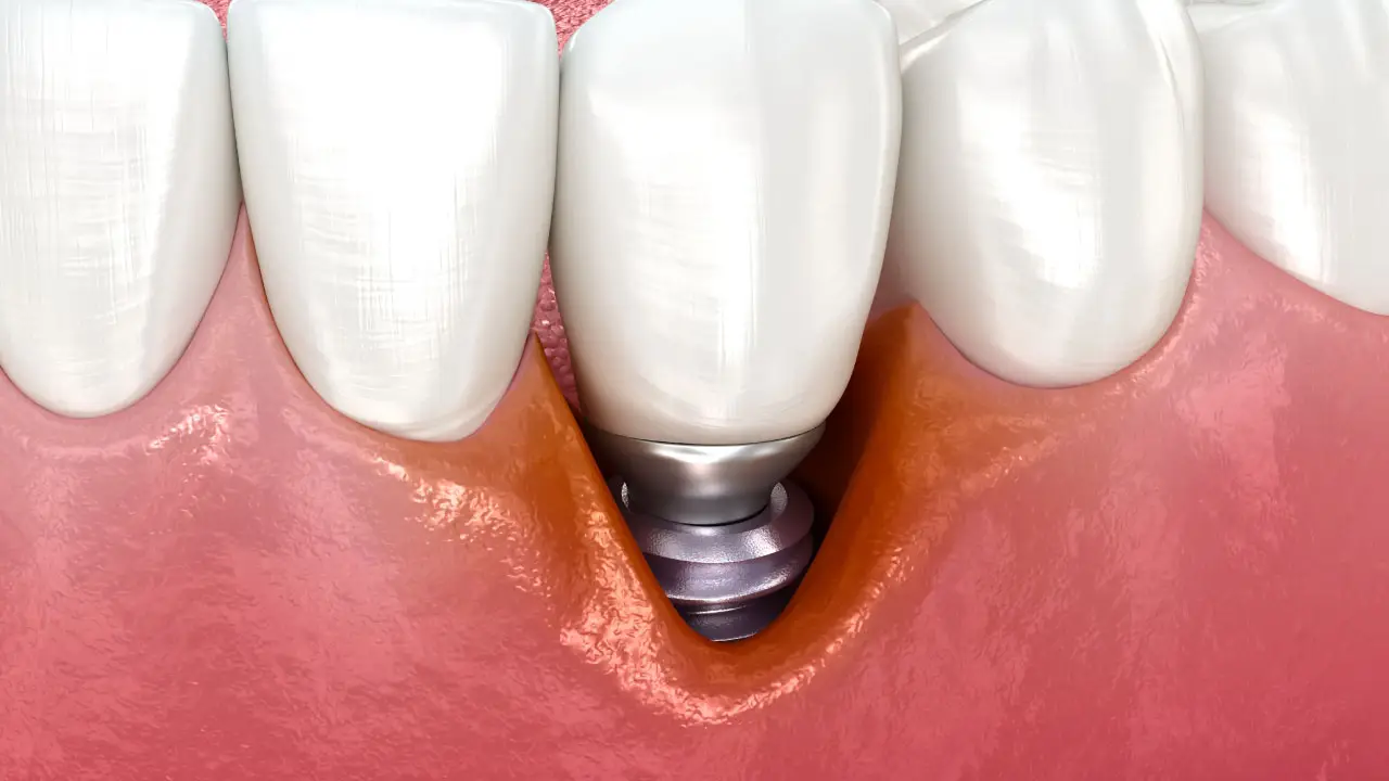 dental implant failure