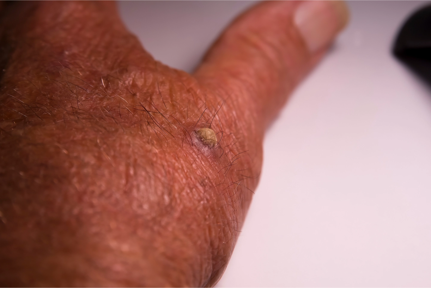 Patient suffer from squamous cell carcinoma on hand