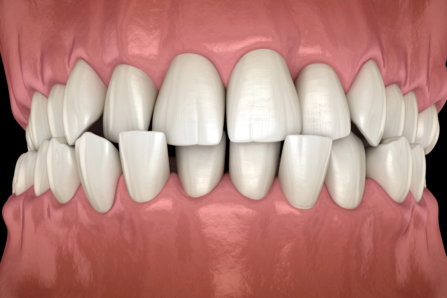 dental crowns