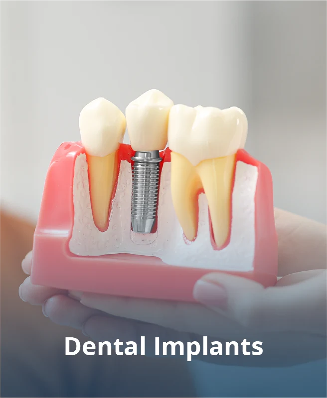 Dental Implant image