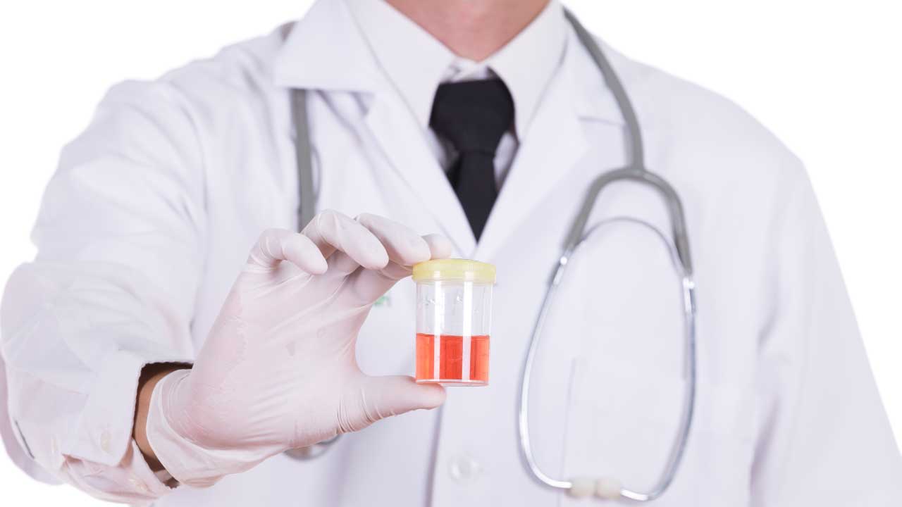 Hematuria What Blood in Urine Means for Your Health