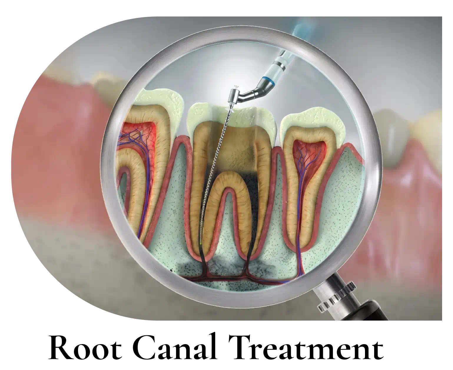 Root Canal Treatment