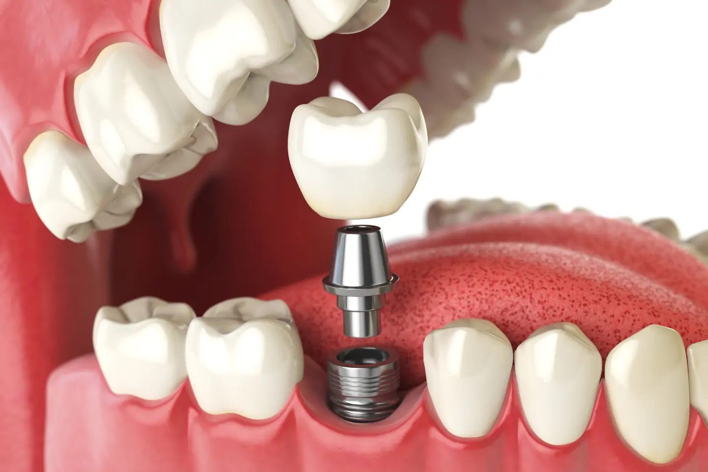 3D illustration of dental implant procedure showing titanium post, abutment, and crown in Roselle, IL