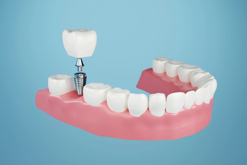 Dental Implants