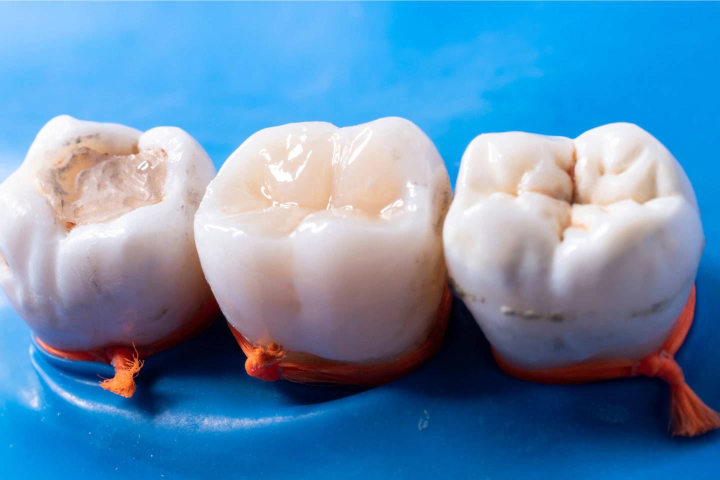 Composite or “Tooth Colored” Fillings