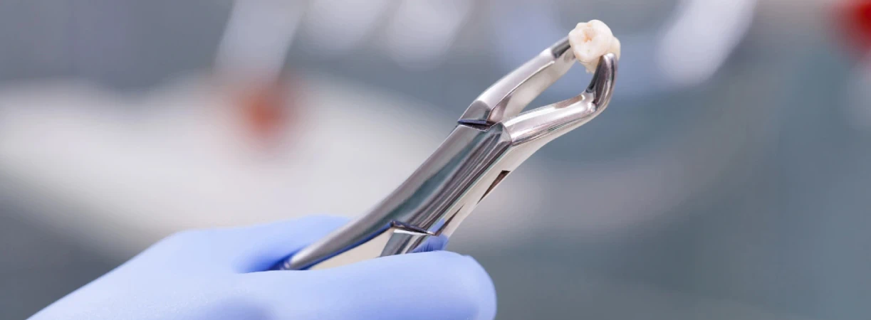 Tooth Extractions in Joliet, IL