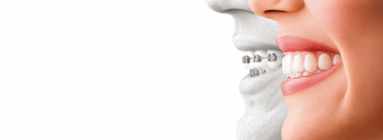 Invisalign Vs Braces