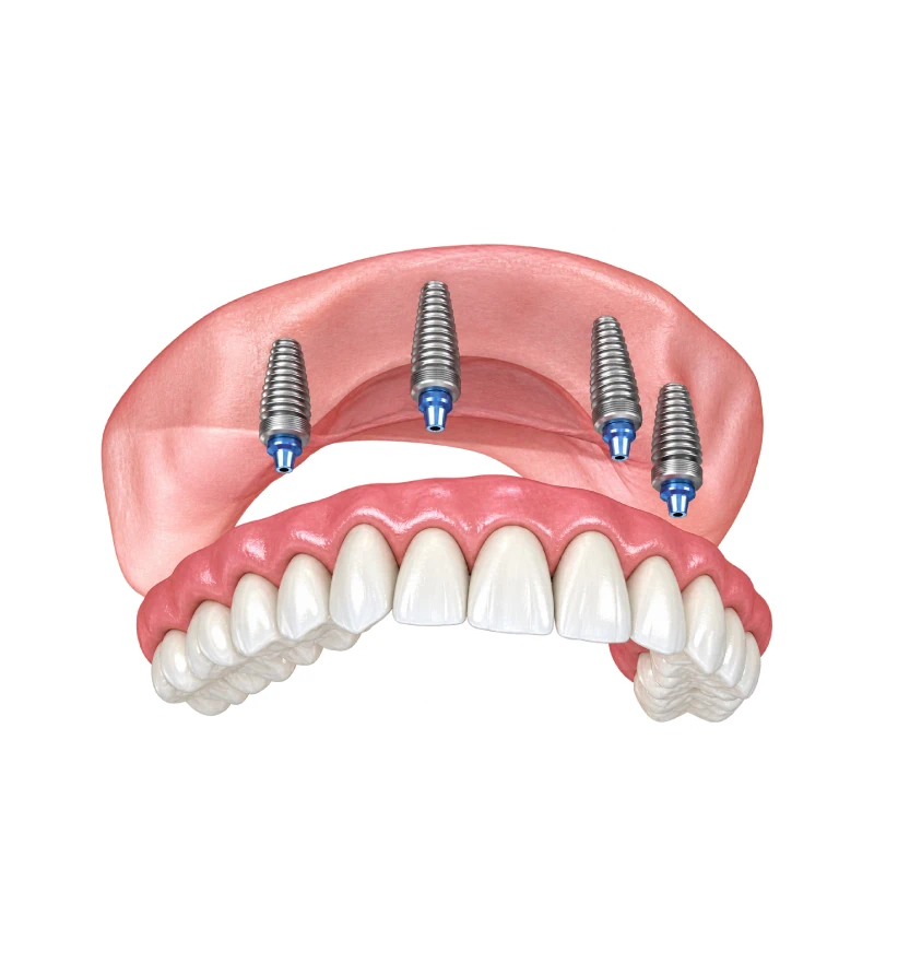 Full mouth dental implant