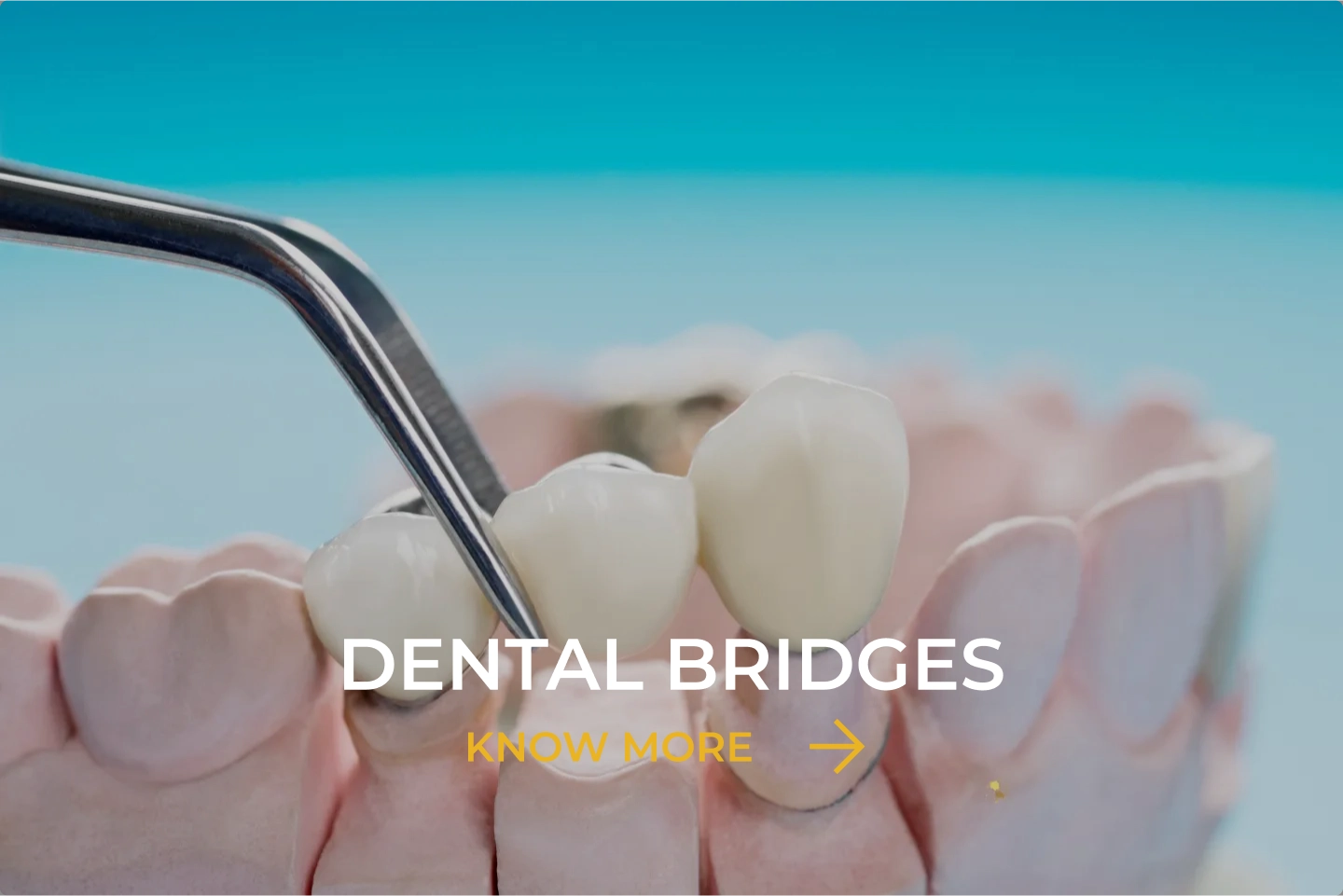 Dental Bridges