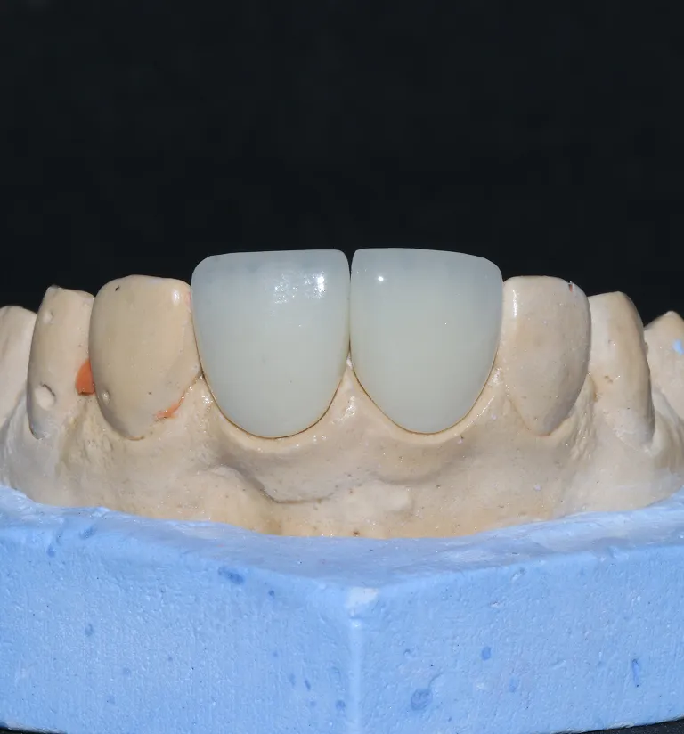 Front Tooth Dental Crown in Annandale, VA