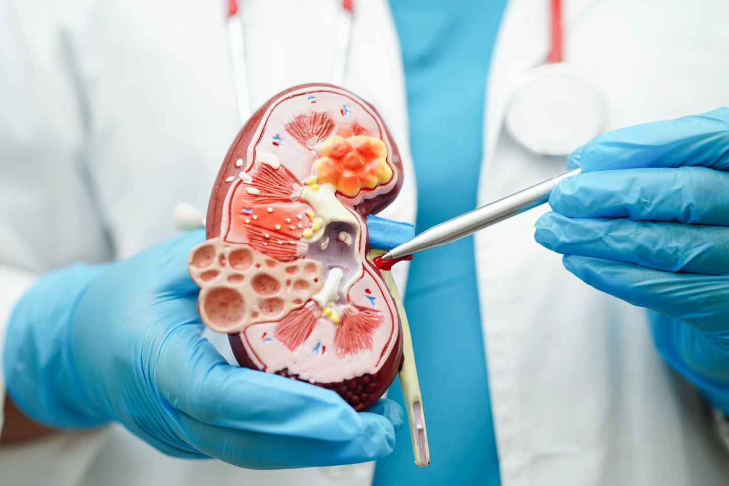 Kidney Failure/Chronic Kidney Disease (CKD)/ End-stage renal diseases (ESRD) Treatments