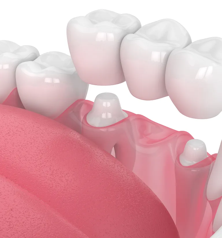 enefits Of Dental Crowns
