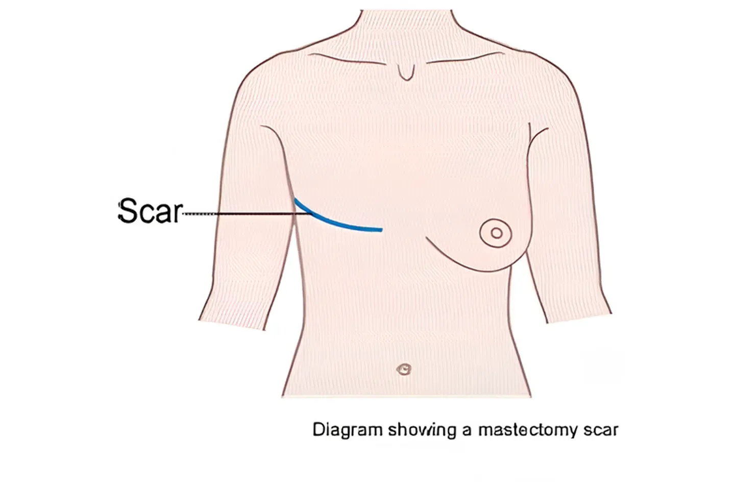 Simple mastectomy illustrative image