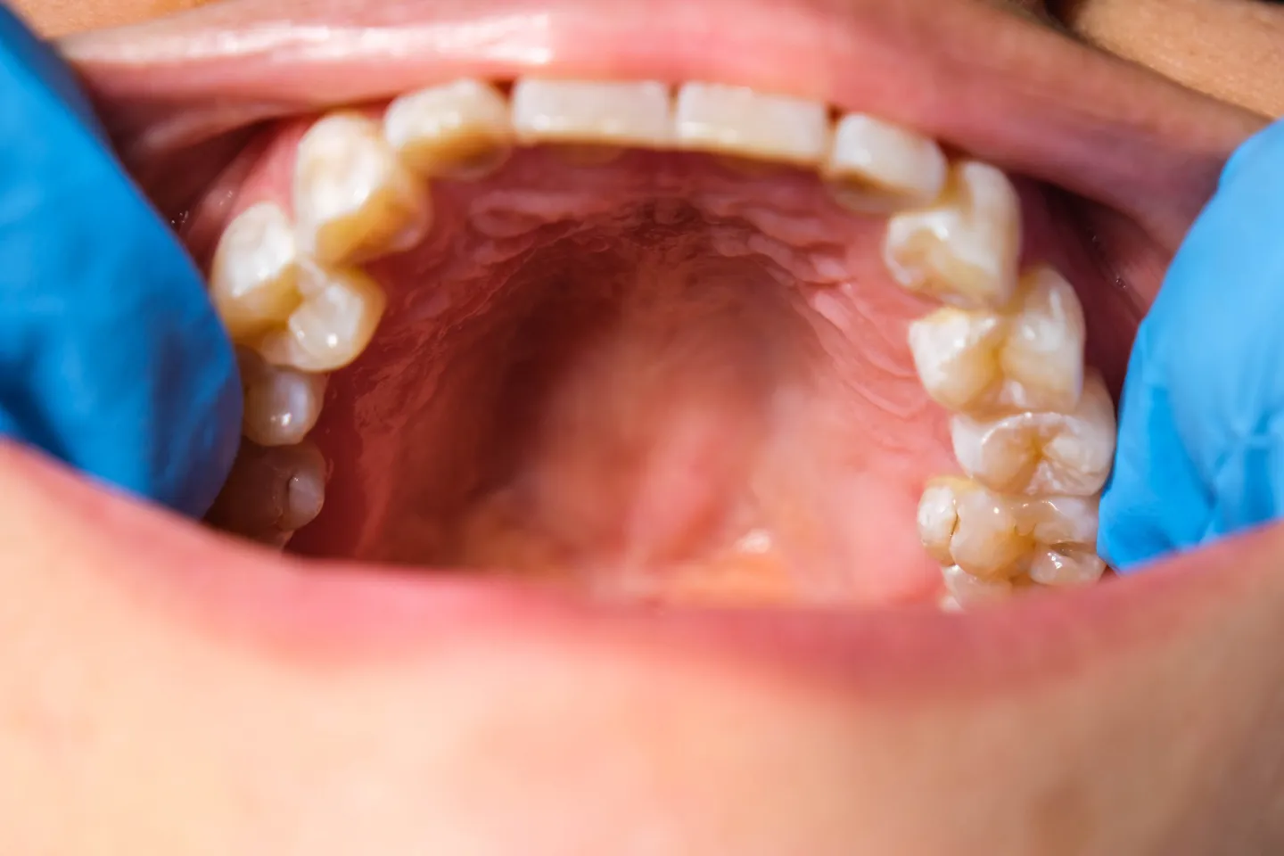 What is the soft palate? -Add Smile Dentistry