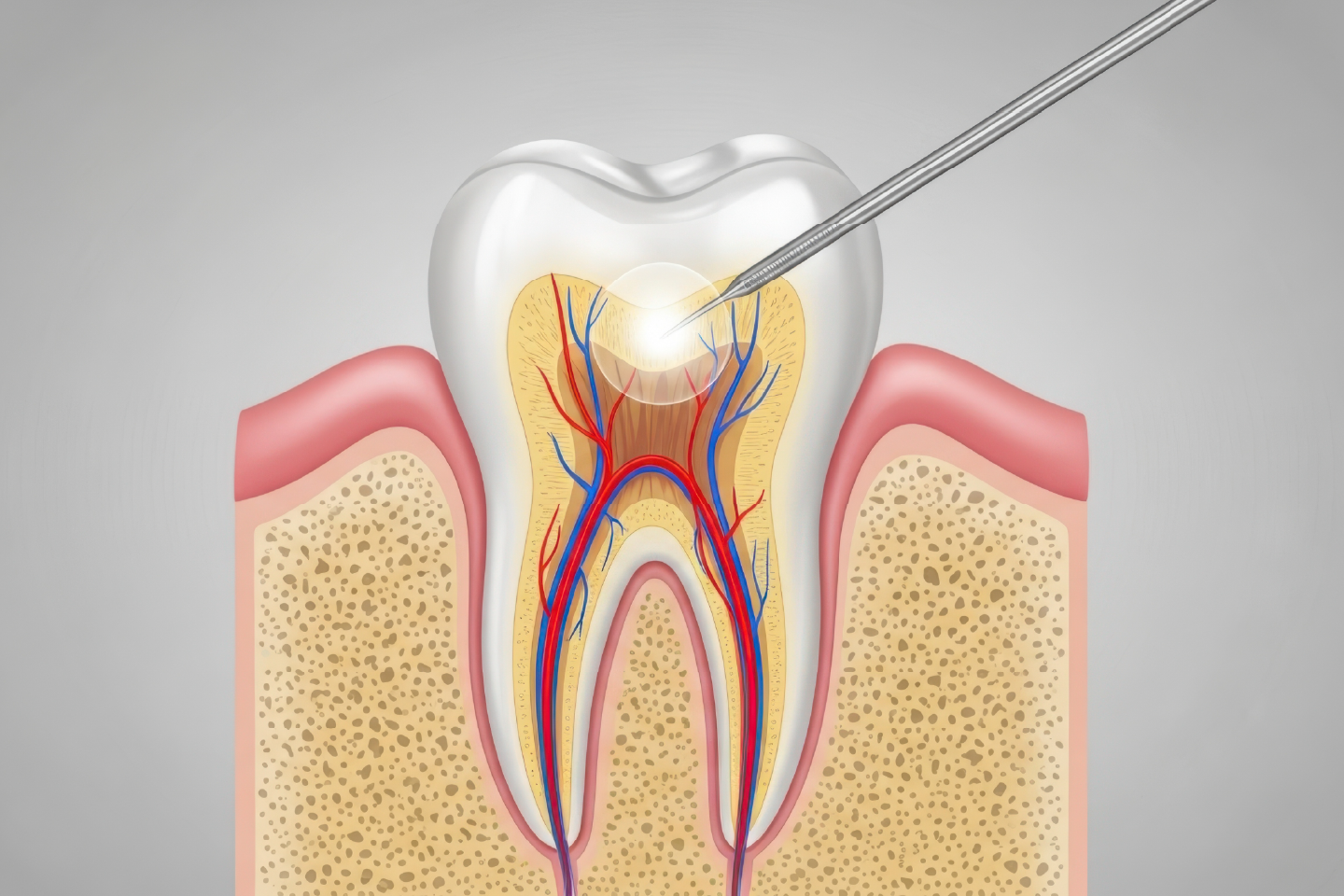 Management of root canal therapy complications