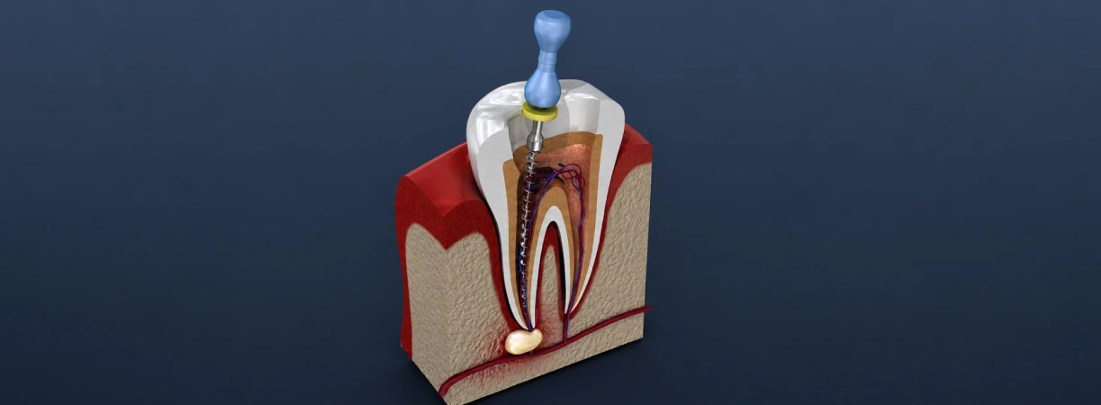 Root Canal Therapy