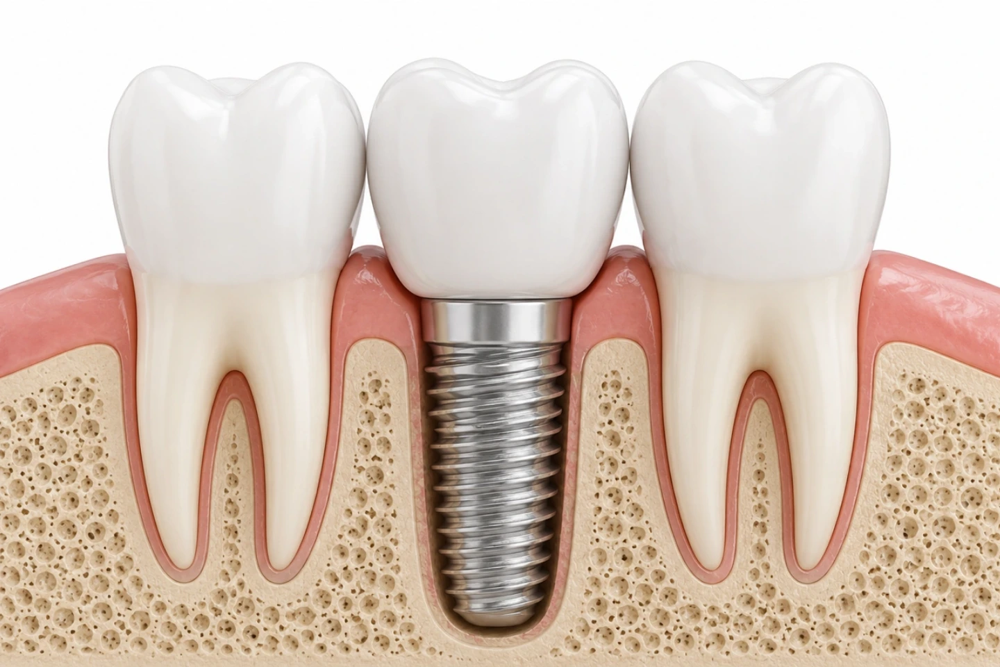 What Is the 3/2 rule for Dental Implant Placement?