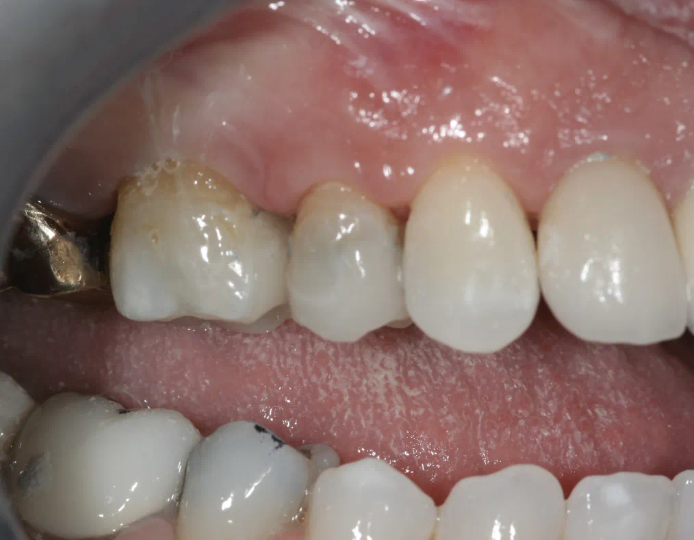 Cerec