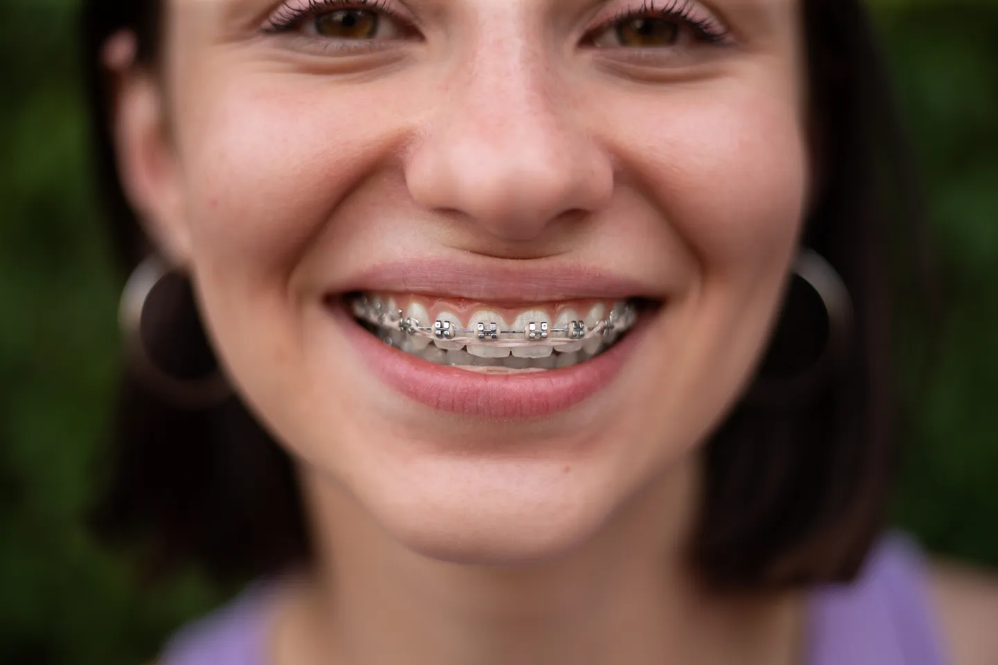 Traditional metal braces fitted on teeth to correct misalignment