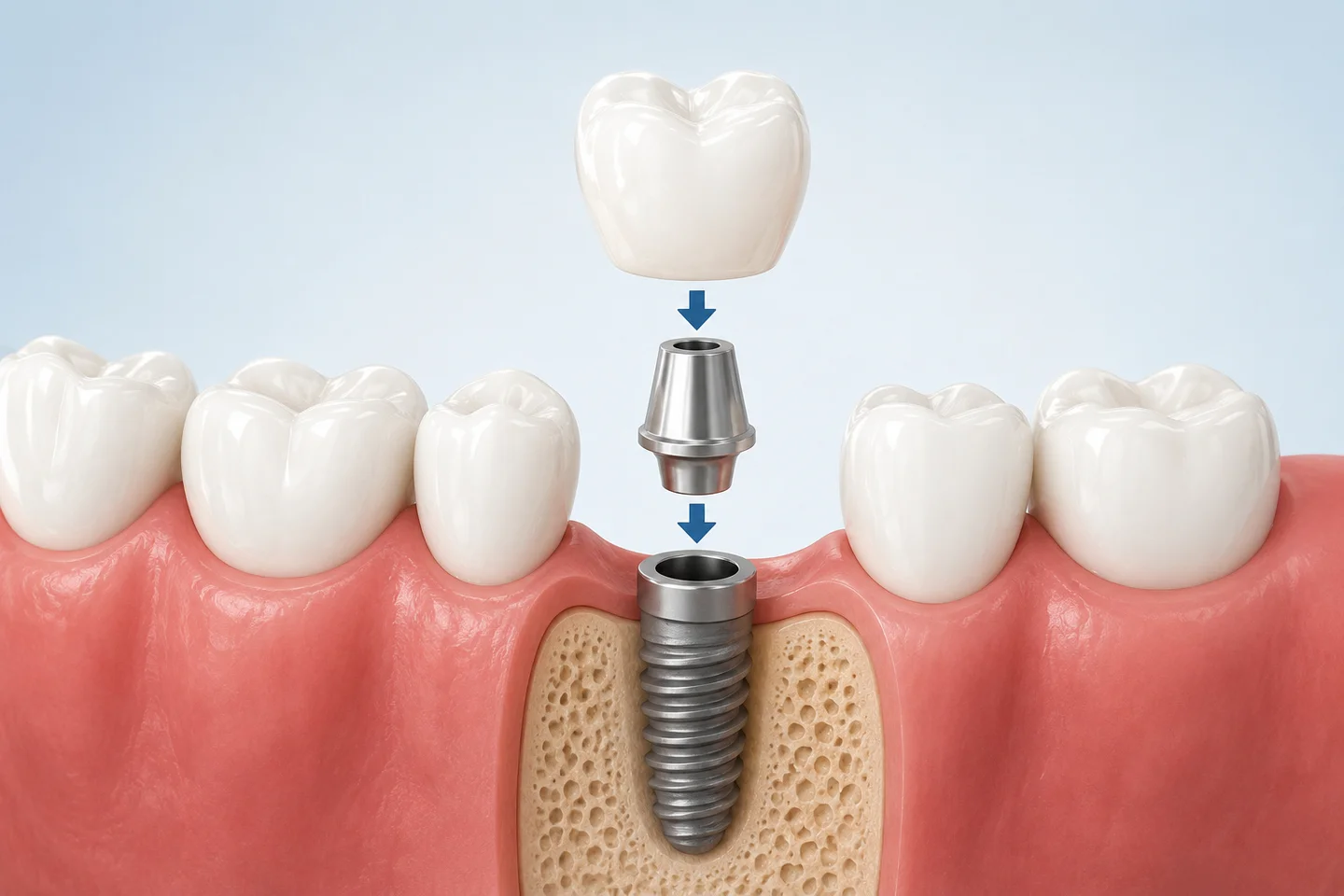 Dental Implant Process in Charlotte | Step-by-Step Guide