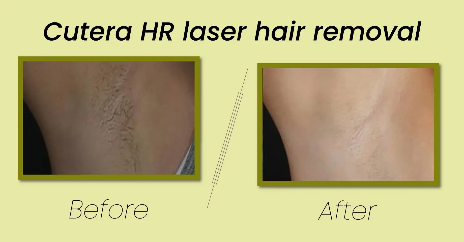 Photo Courtesy for Laser hair removal treatment with us