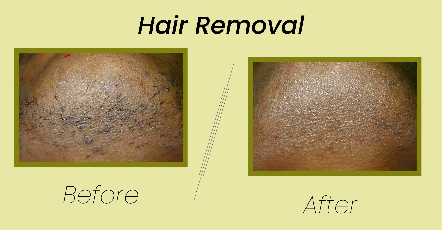 Photo of laser hair removal which give great output