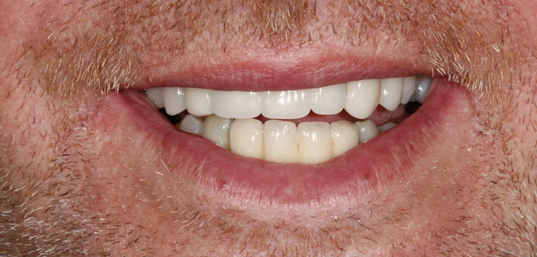 Can Anyone Get Dental Implants? Understanding Your Candidacy