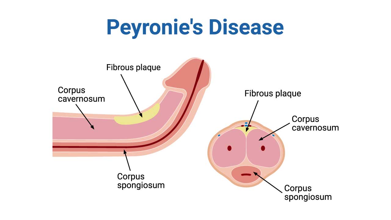 Understanding & Treating Peyronie’s Disease