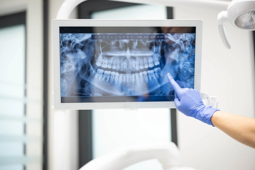 What Are Digital Dental X-Rays