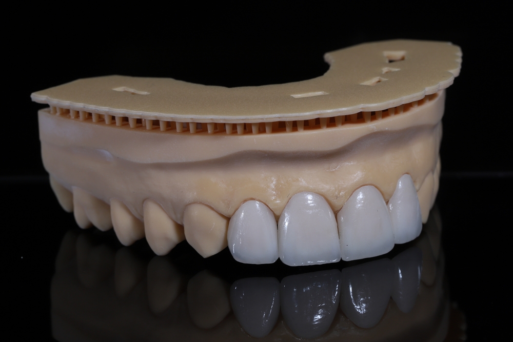 Dental Veneers