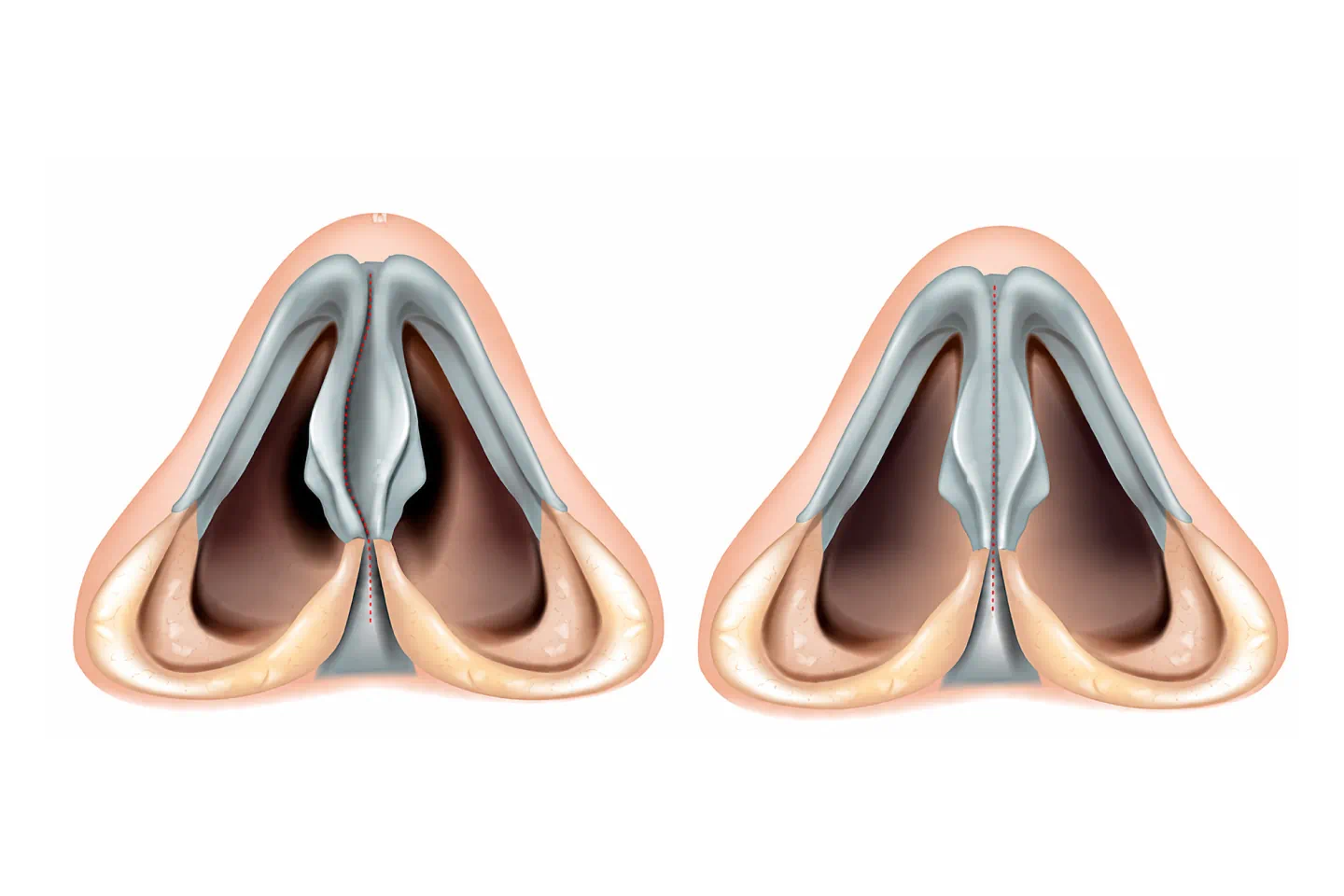 Turbinoplasty/Turbinectomy