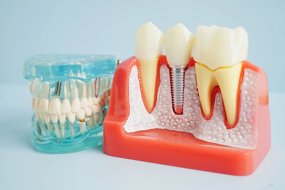 All-on-4 Dental Implants in Bloomingdale, IL