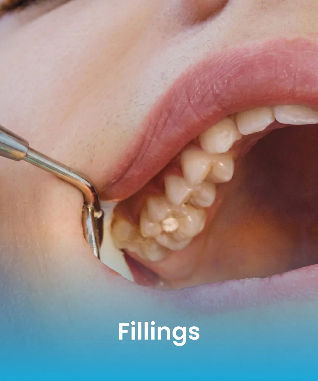 Dentist placing a tooth-colored filling