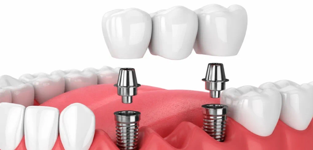 Why More Adults Are Choosing Dental Implants Over Traditional Bridges