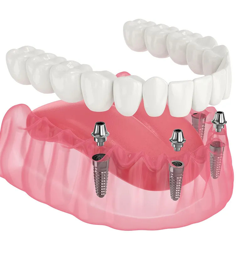 Understanding the Role of Dental Implants in Preventing Bone Loss